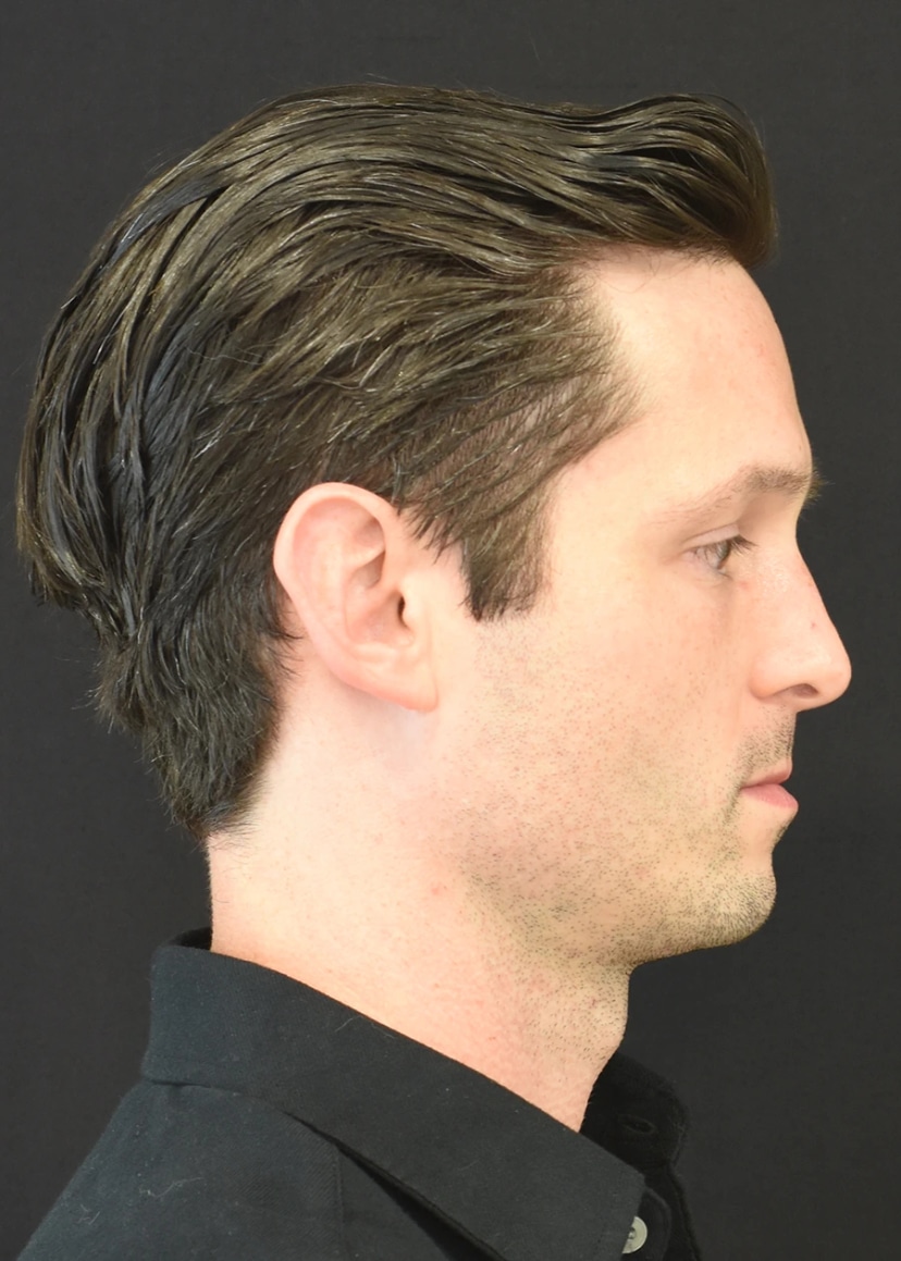 Rhinoplasty Patient 7 Set 3 Before