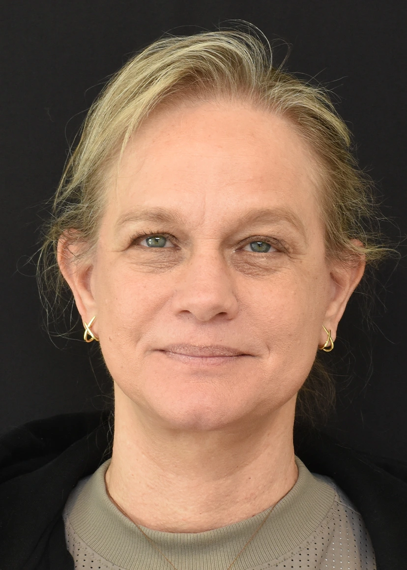 Deep Plane Facelift Patient 32 Set 1 After